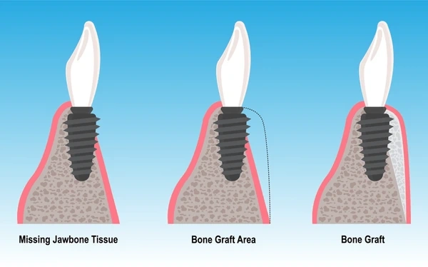 bone grafting in north port fl