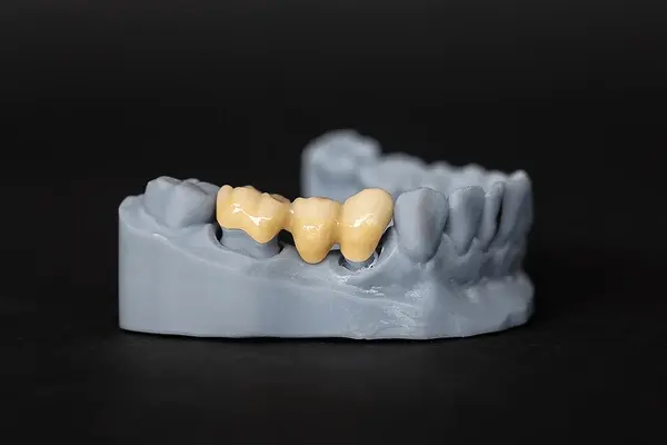 dental bridges near you
