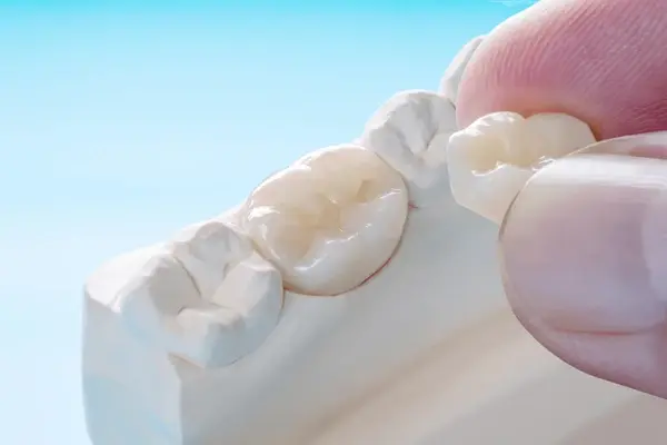 dental crowns in north port fl