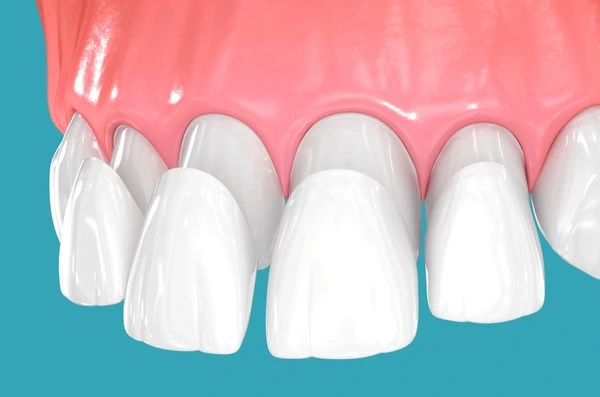 dental veneers in north port fl
