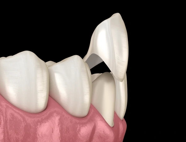 dental veneers near you