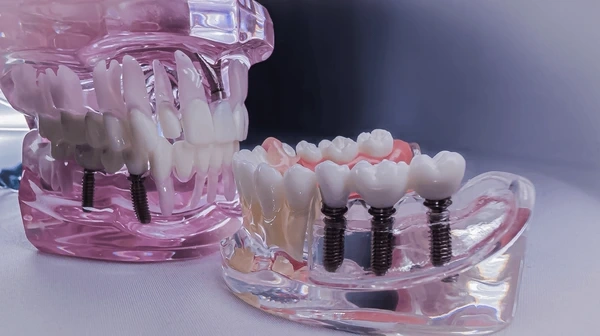 implant dentistry in north port fl