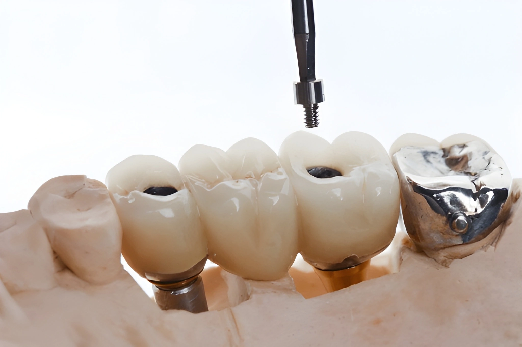 implant over dentures near you