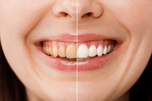 teeth whitening near you